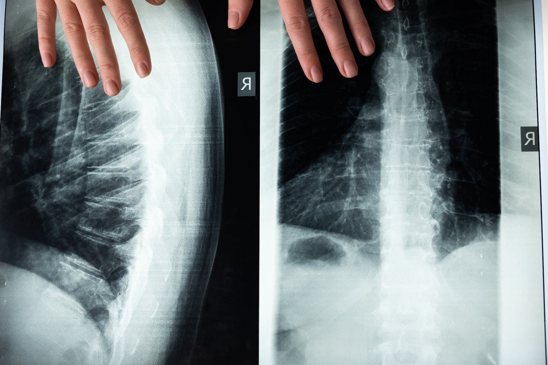 Collard greens can improve bone density (Image via Pexels/cottonbro studio)